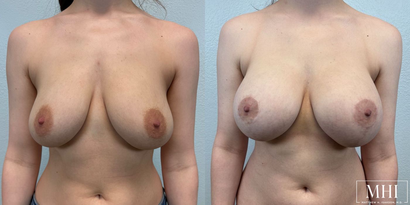 Breast Augmentation with Lift - Case 12132