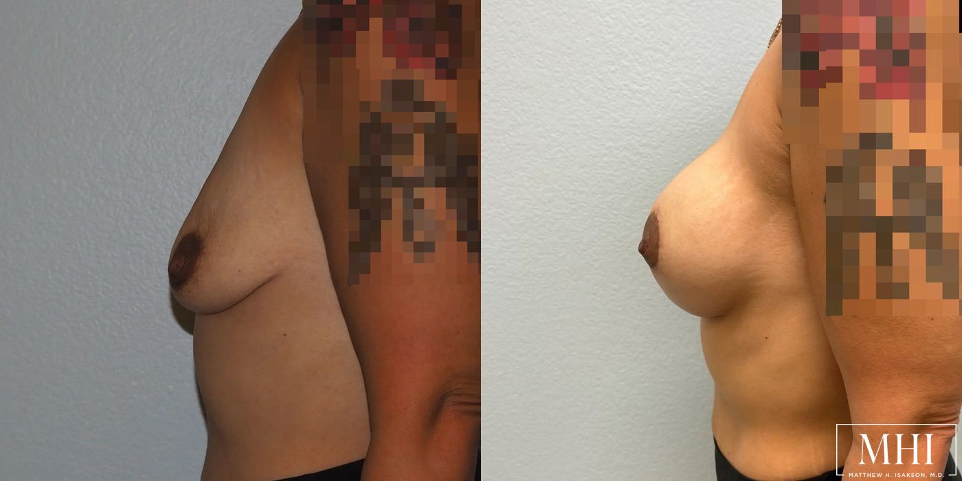 Breast Augmentation with Lift - Thumbnail 5