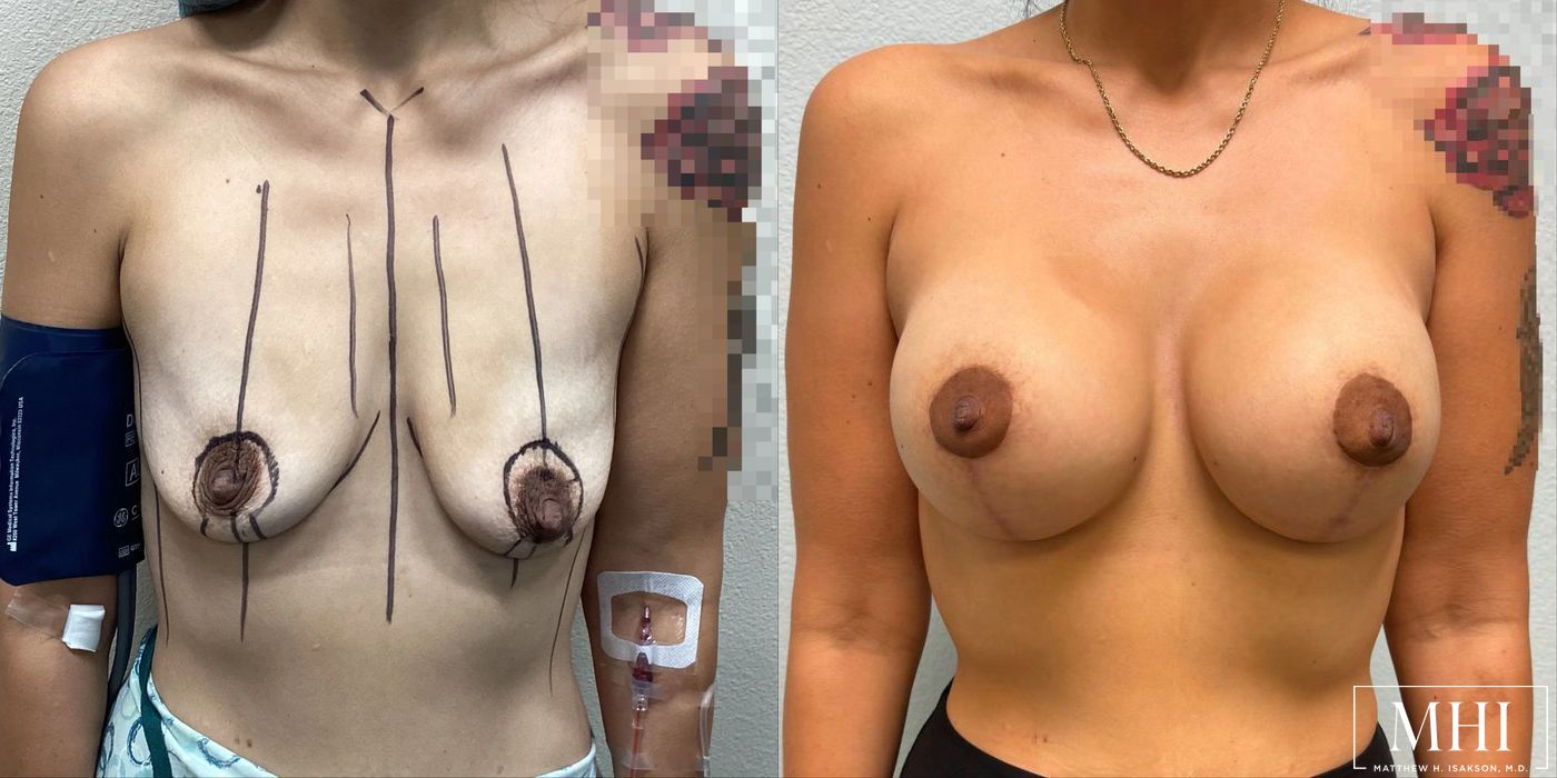 Breast Augmentation with Lift - Case 12451