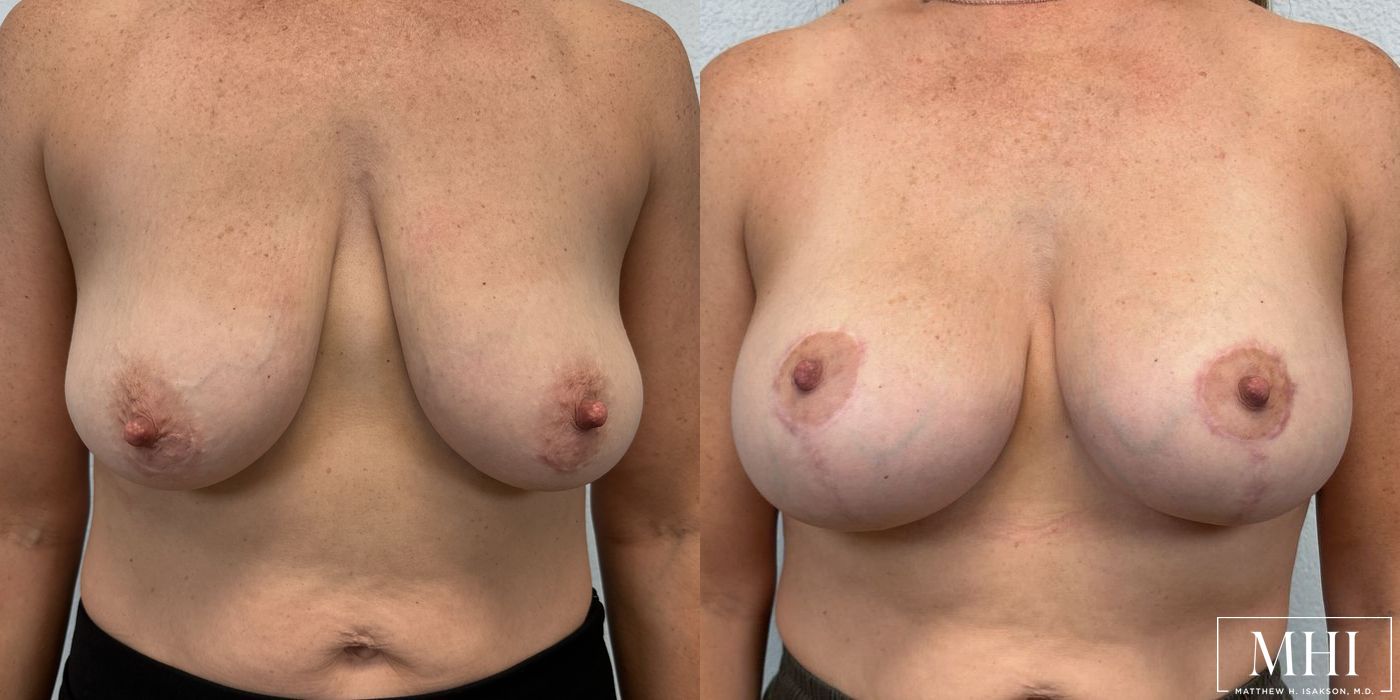 Breast Augmentation with Lift - Case 12128