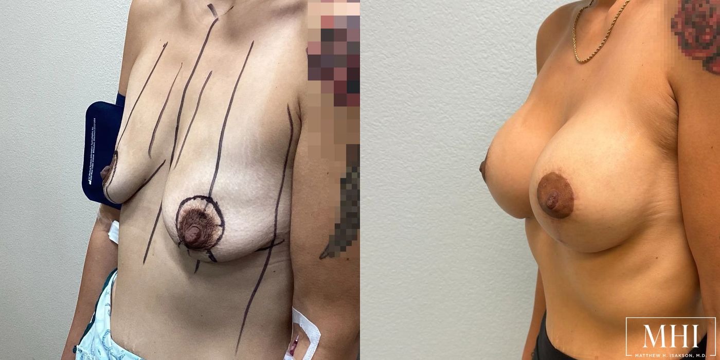 Breast Augmentation with Lift - Thumbnail 4