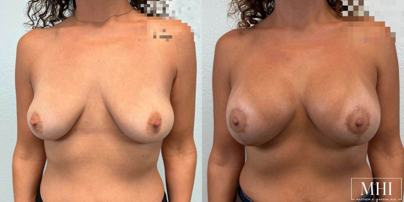 Breast Augmentation with Lift - Case 12450