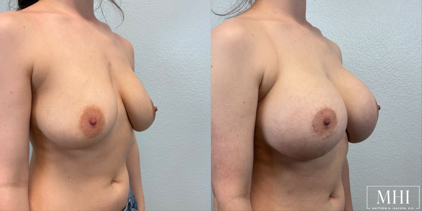 Breast Augmentation with Lift - Thumbnail 4