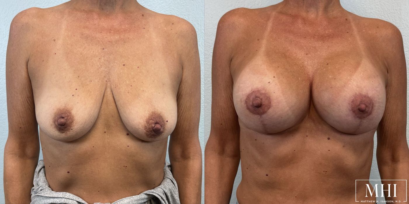 Breast Augmentation with Lift - Case 12130