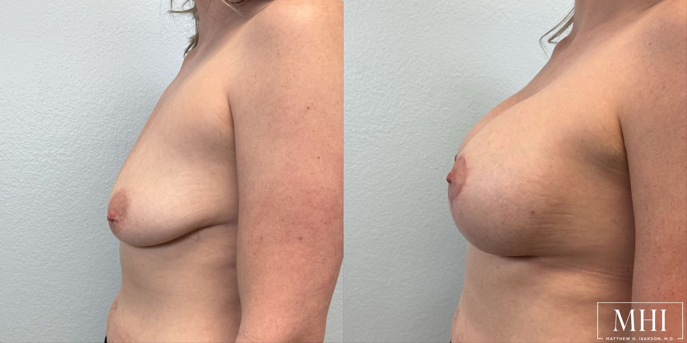 Breast Augmentation with Lift - Thumbnail 3