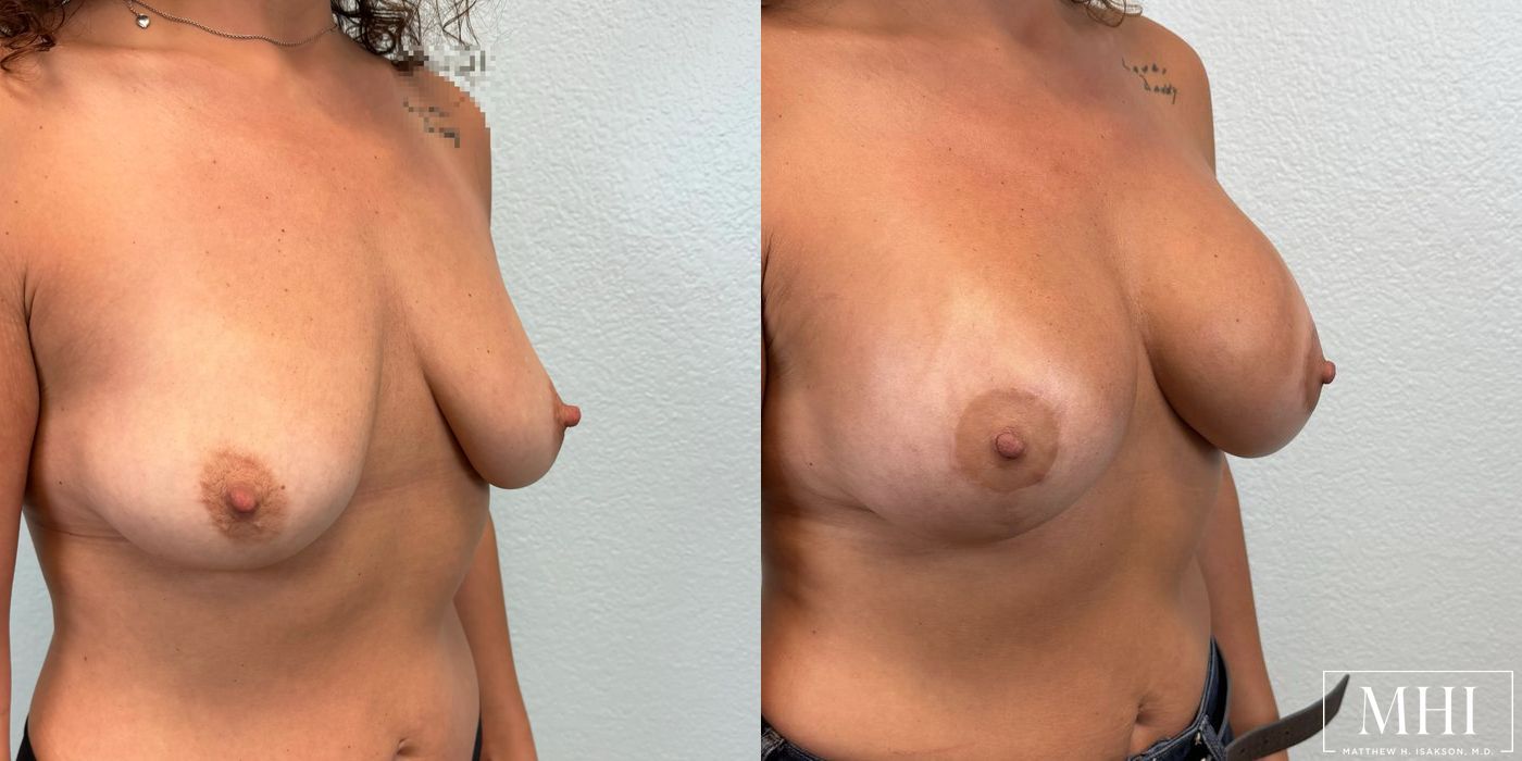 Breast Augmentation with Lift - Thumbnail 4