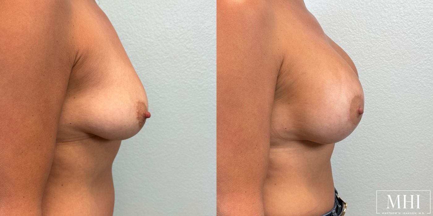 Breast Augmentation with Lift - Thumbnail 5