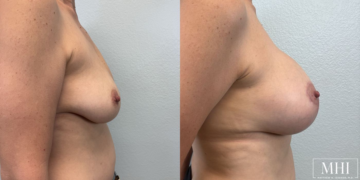 Breast Augmentation with Lift - Thumbnail 5