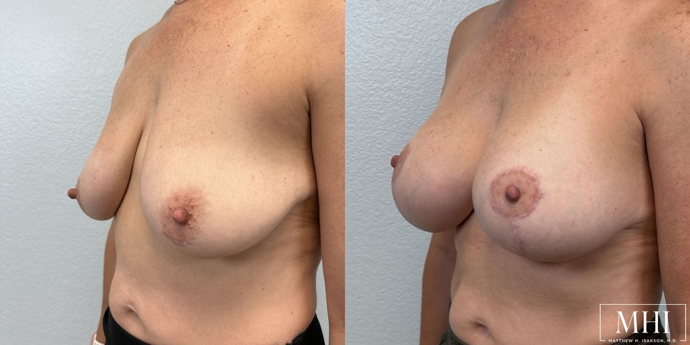 Breast Augmentation with Lift - Thumbnail 2