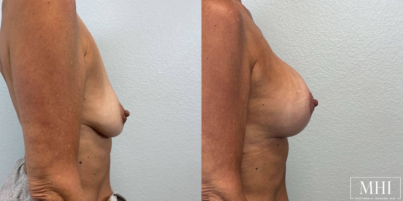 Breast Augmentation with Lift - Thumbnail 5