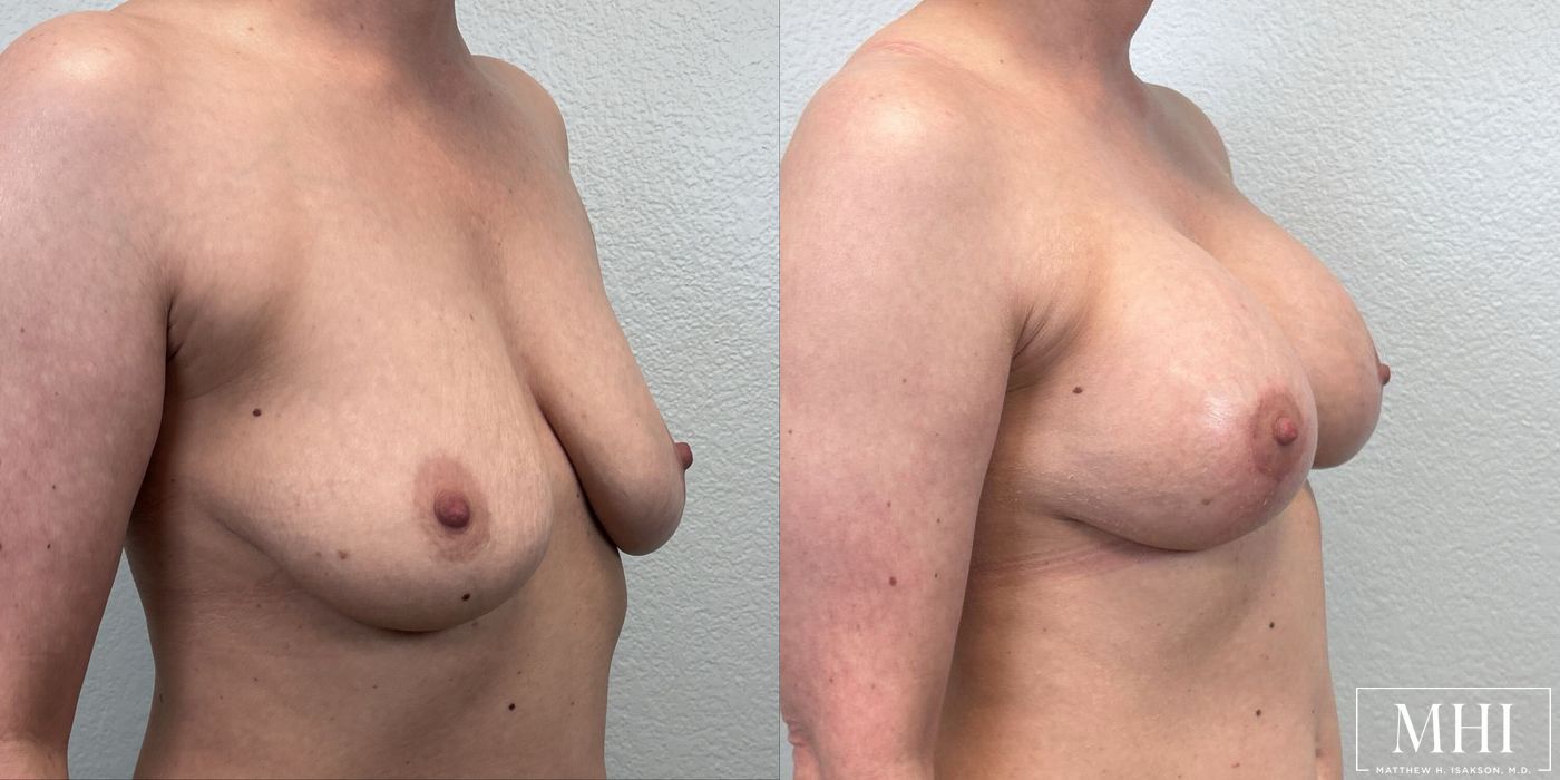 Breast Augmentation with Lift - Thumbnail 4