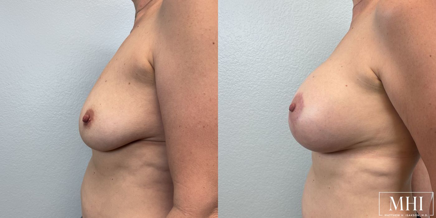 Breast Augmentation with Lift - Thumbnail 2