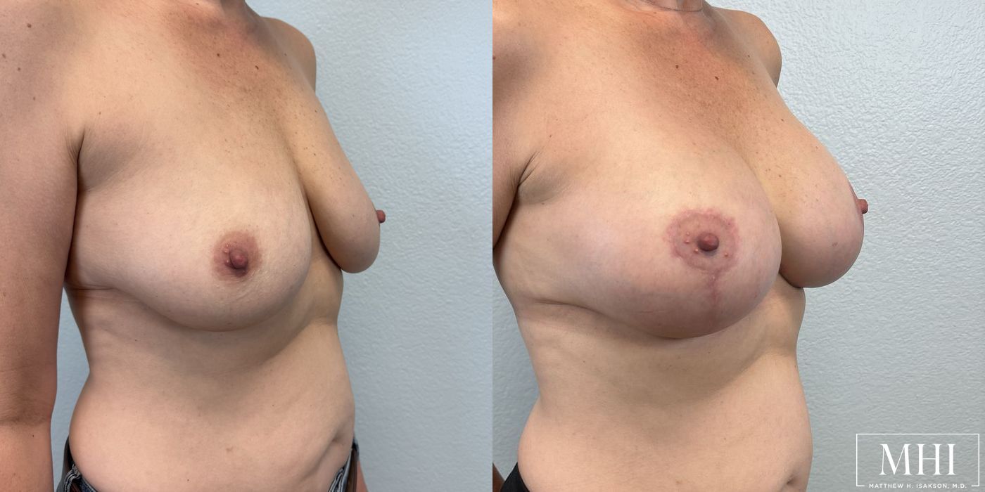 Breast Augmentation with Lift - Thumbnail 4