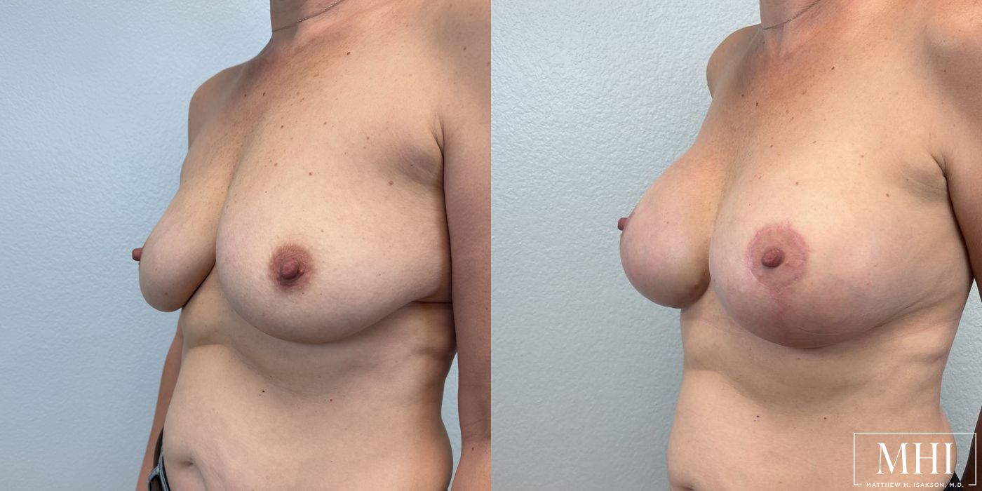 Breast Augmentation with Lift - Case 12458
