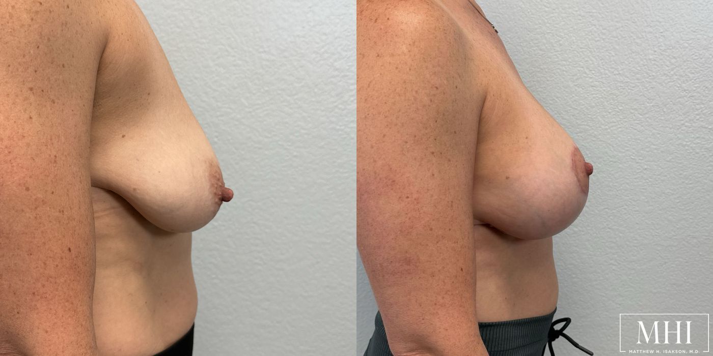 Breast Augmentation with Lift - Thumbnail 5