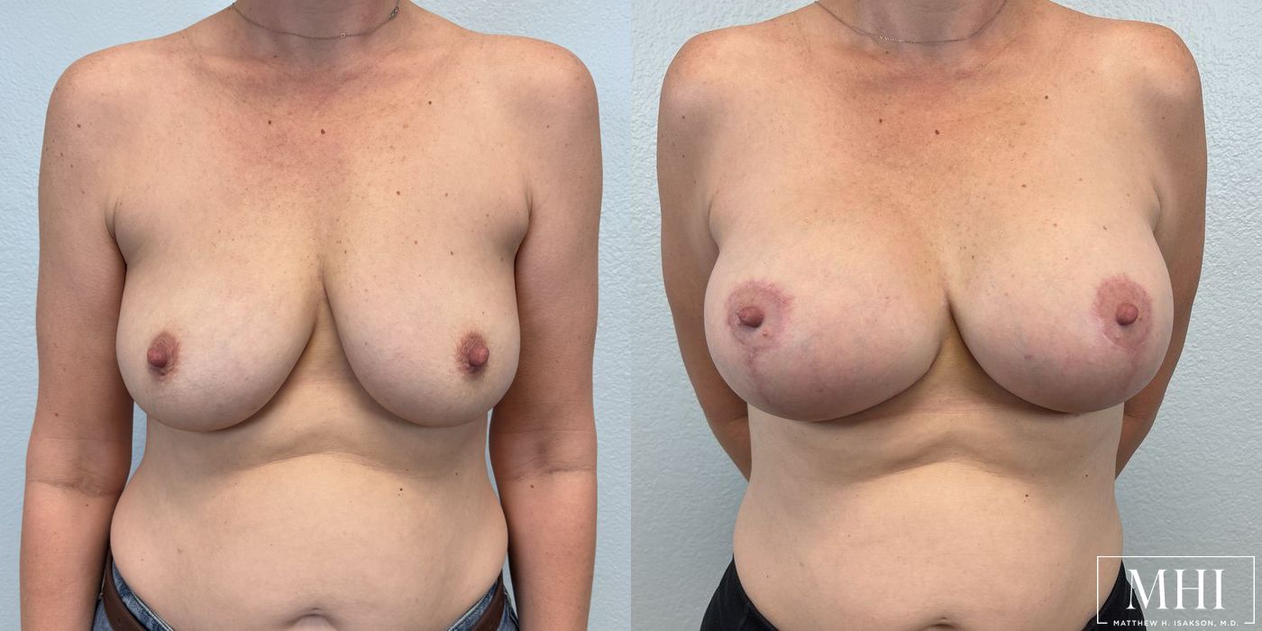 Breast Augmentation with Lift - Thumbnail 3