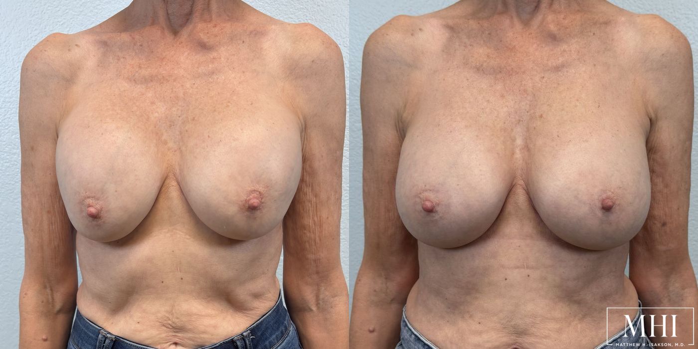 Breast Implant Exchange - Thumbnail 2