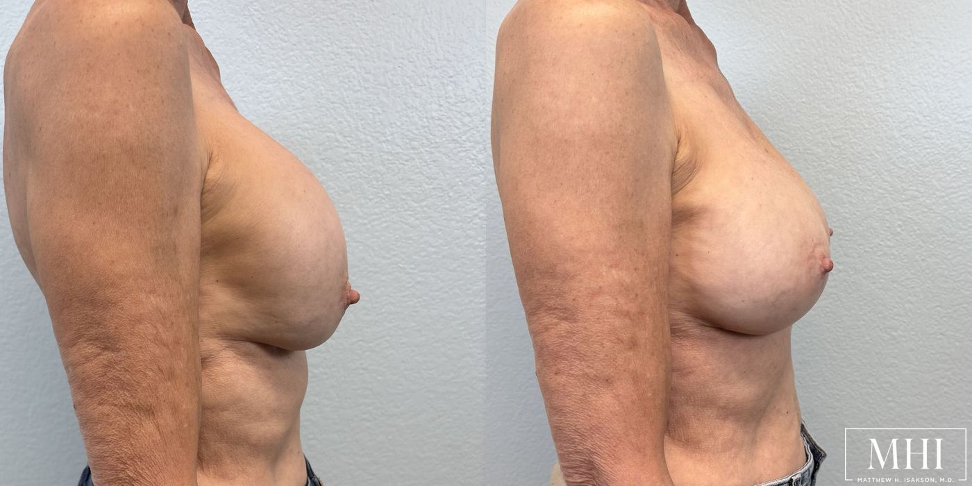 Breast Implant Exchange - Thumbnail 4