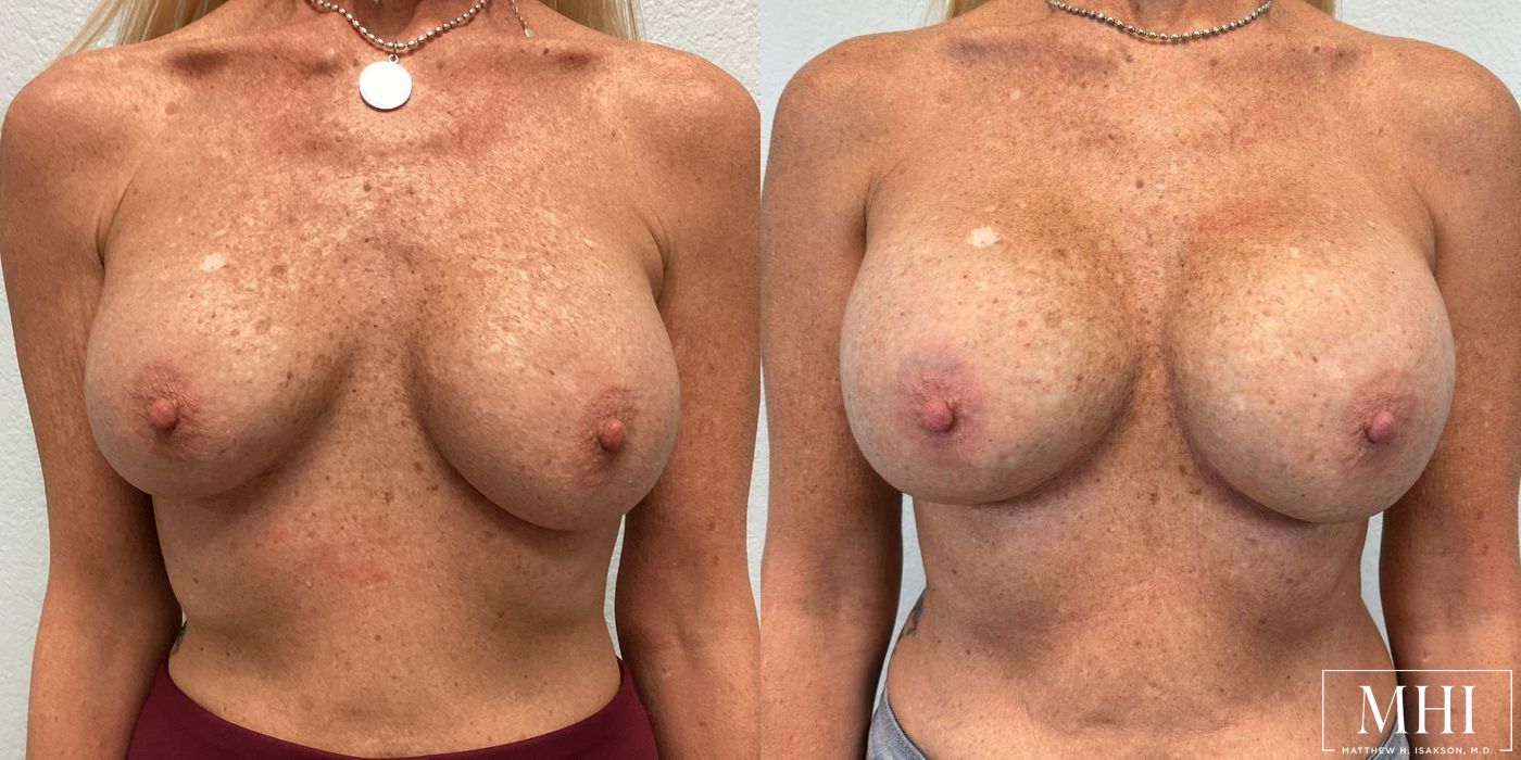 Breast Implant Exchange - Case 12463