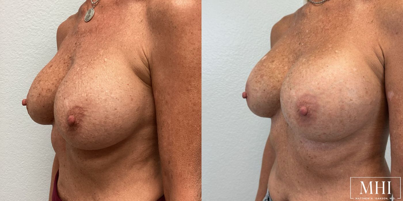 Breast Implant Exchange - Thumbnail 3