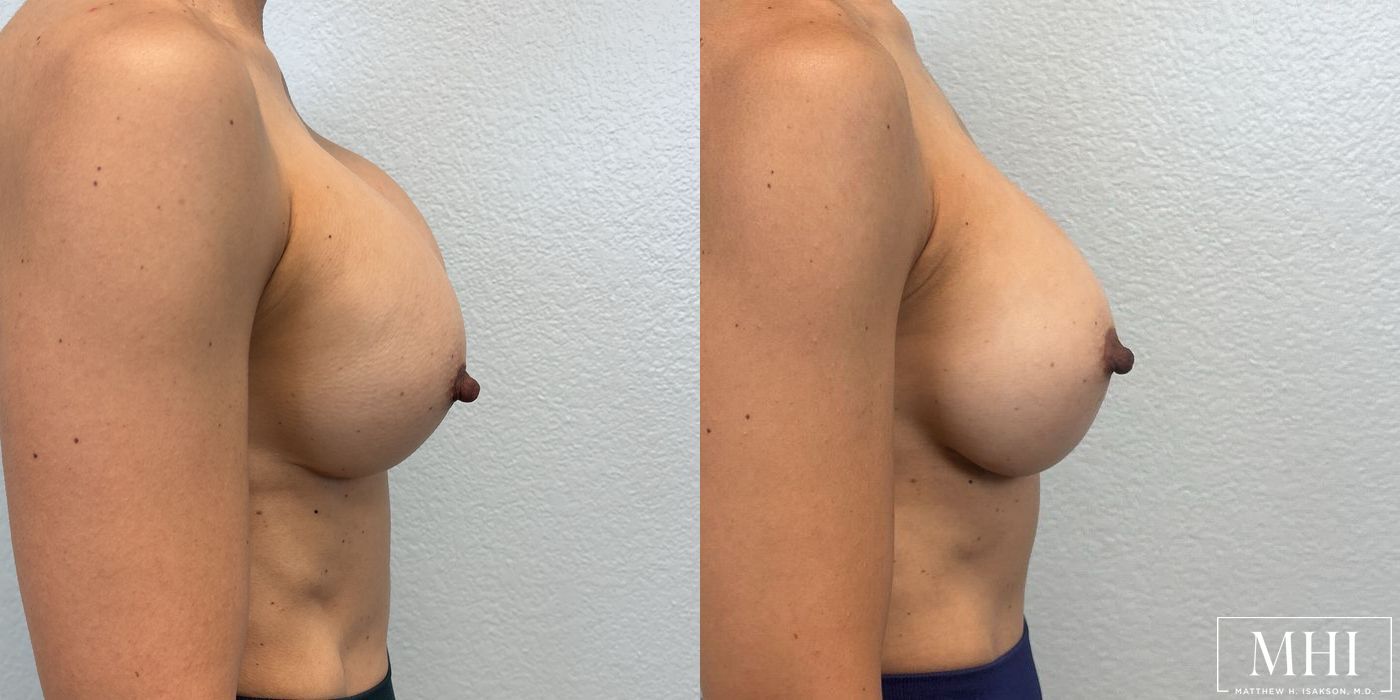 Breast Implant Exchange - Thumbnail 4