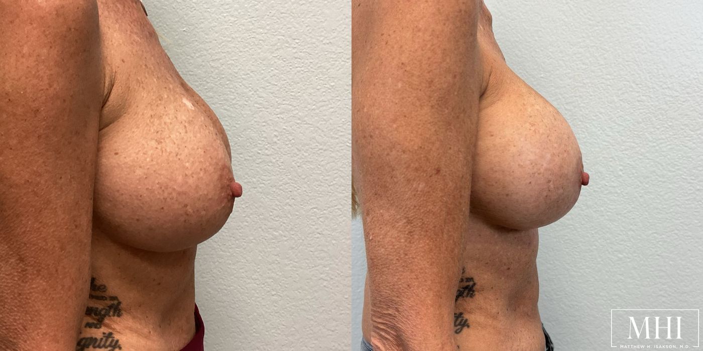 Breast Implant Exchange - Thumbnail 6