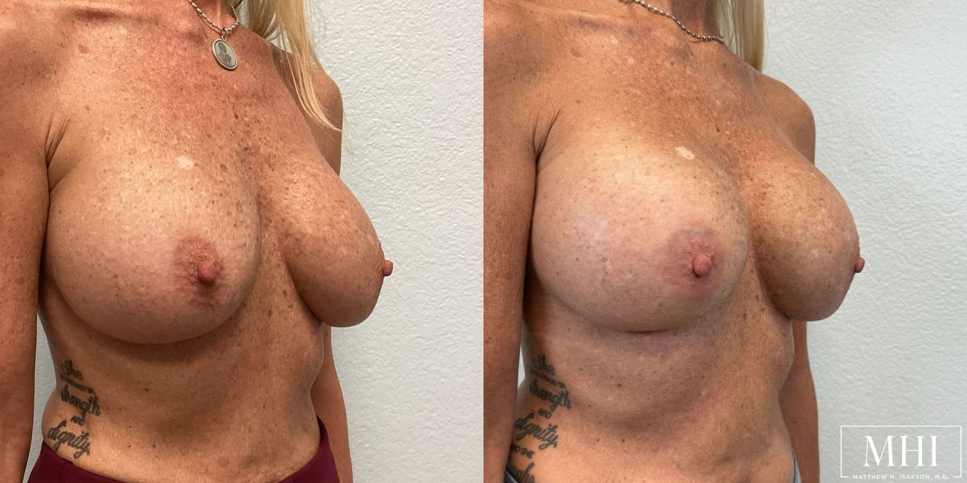 Breast Implant Exchange - Thumbnail 5