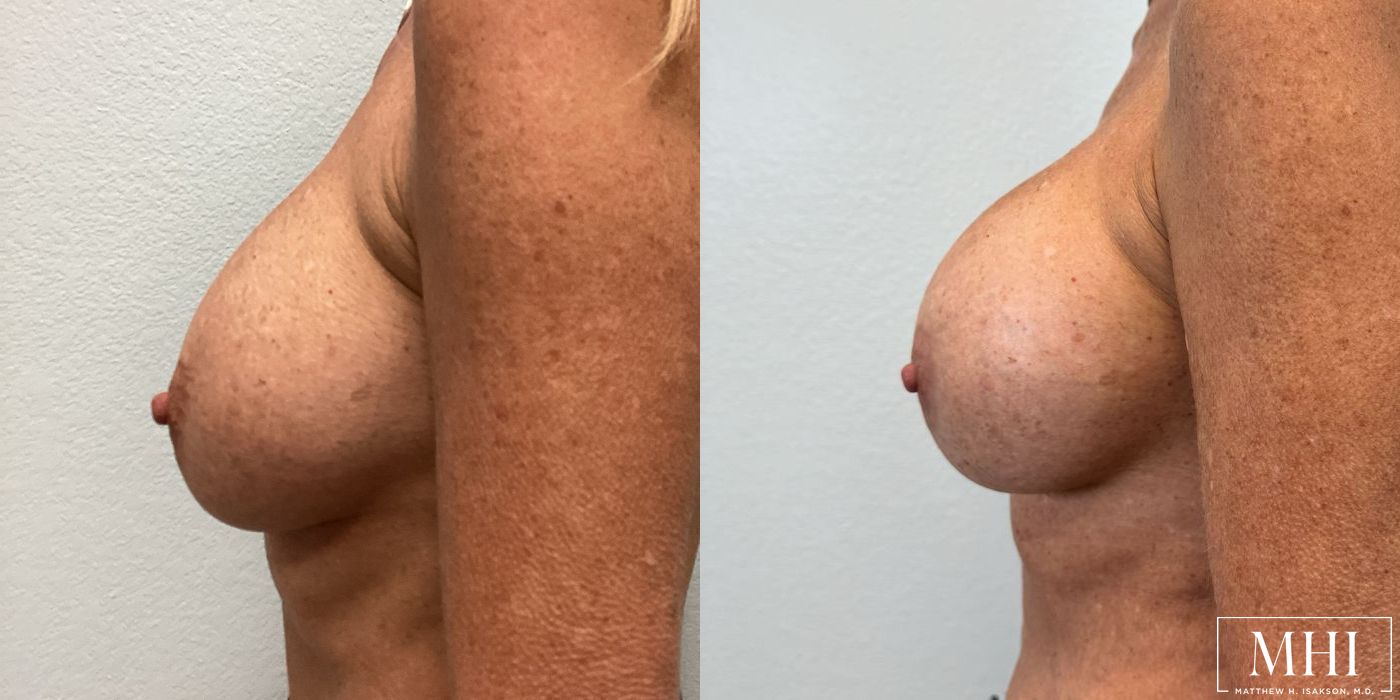 Breast Implant Exchange - Thumbnail 4