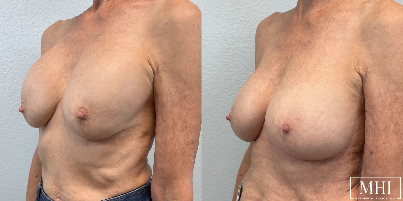 Breast Implant Exchange - Case 12138