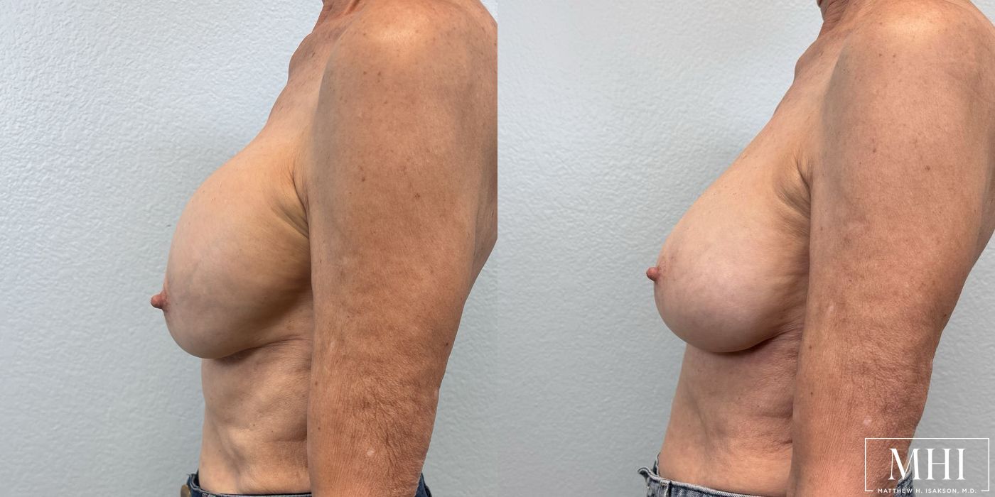 Breast Implant Exchange - Thumbnail 3