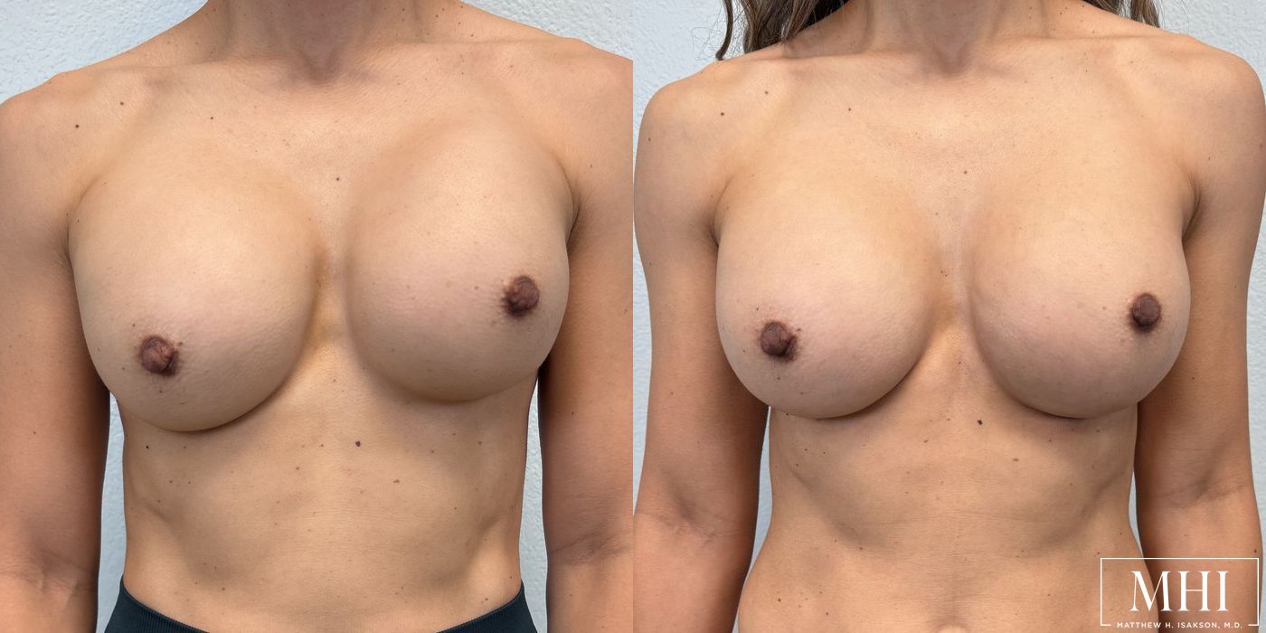 Breast Implant Exchange - Case 12135