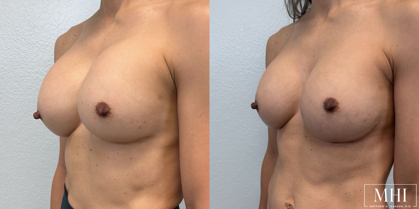 Breast Implant Exchange - Thumbnail 2