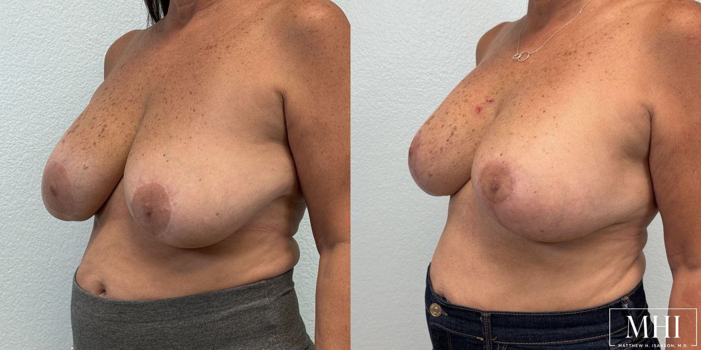 Breast Implant Exchange - Thumbnail 4