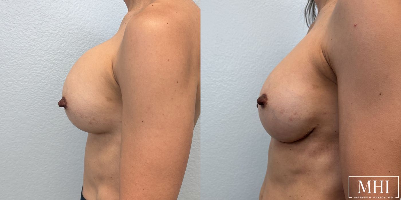 Breast Implant Exchange - Thumbnail 3