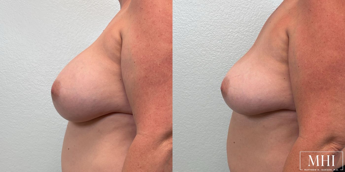 Breast Implant Removal - Thumbnail 3