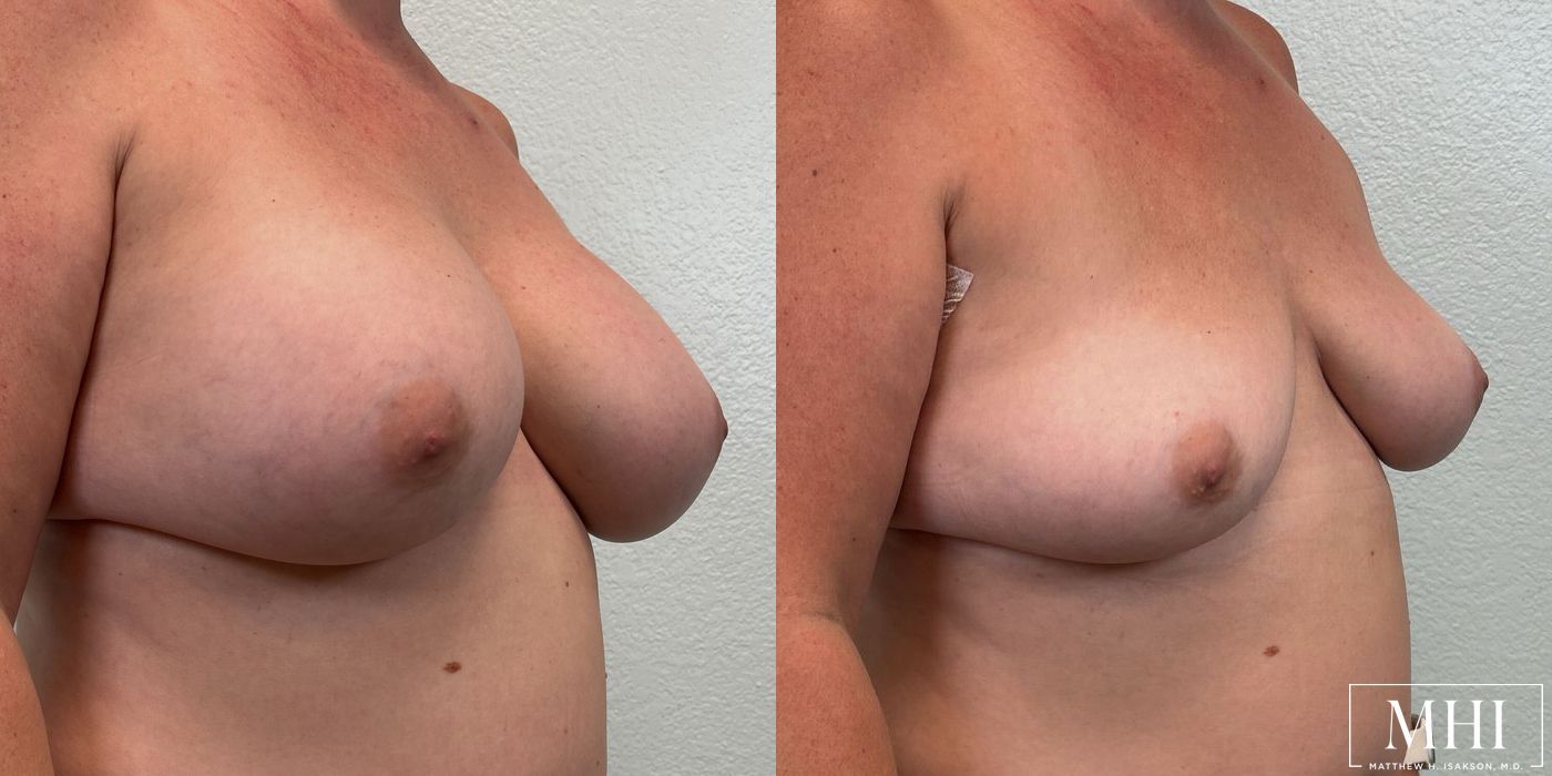 Breast Implant Removal - Thumbnail 4