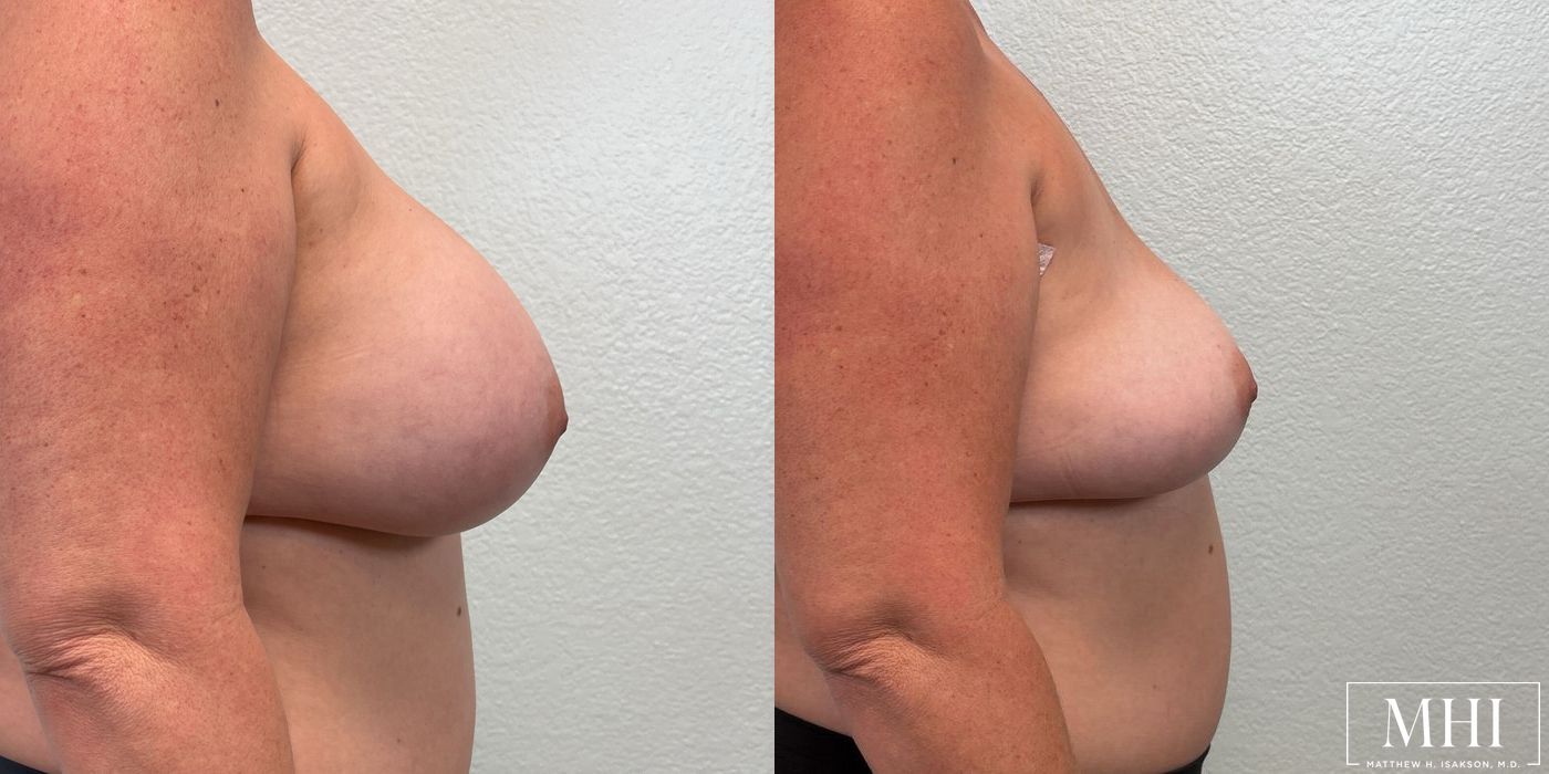 Breast Implant Removal - Thumbnail 5