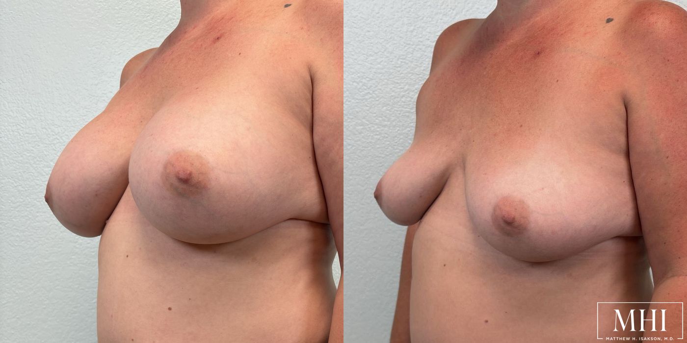 Breast Implant Removal - Thumbnail 2