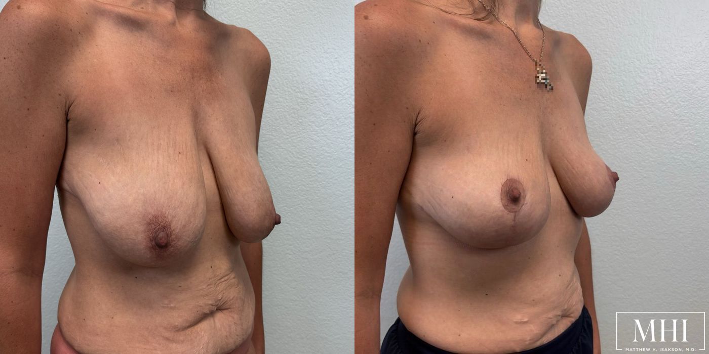 Breast Lift - Case 12156