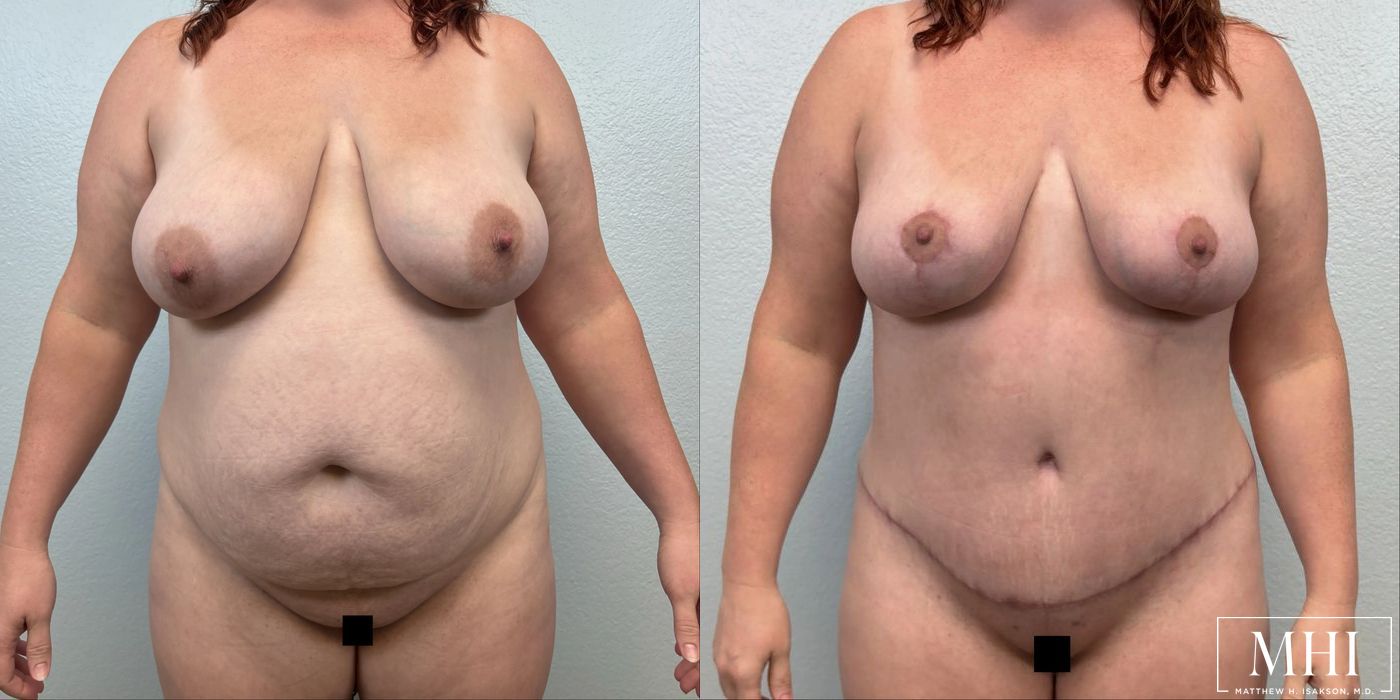 Breast Lift - Case 12164