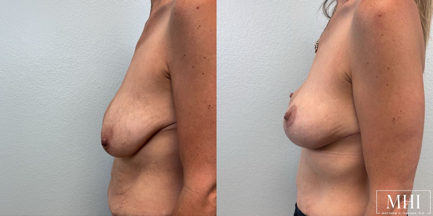 Breast Lift - Thumbnail 3