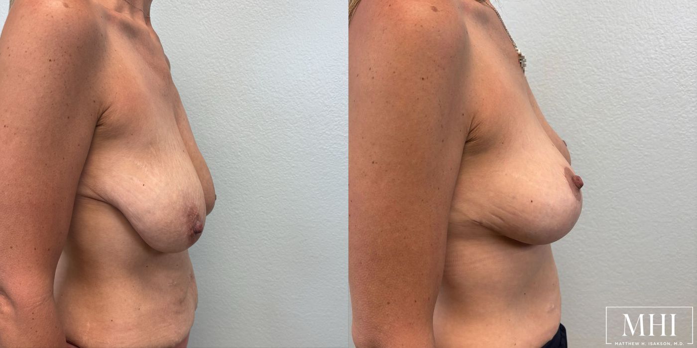 Breast Lift - Thumbnail 2