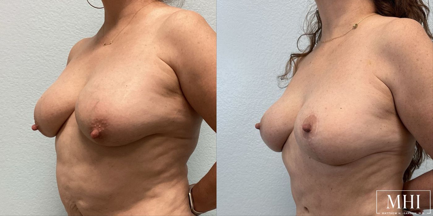 Breast Lift - Thumbnail 2