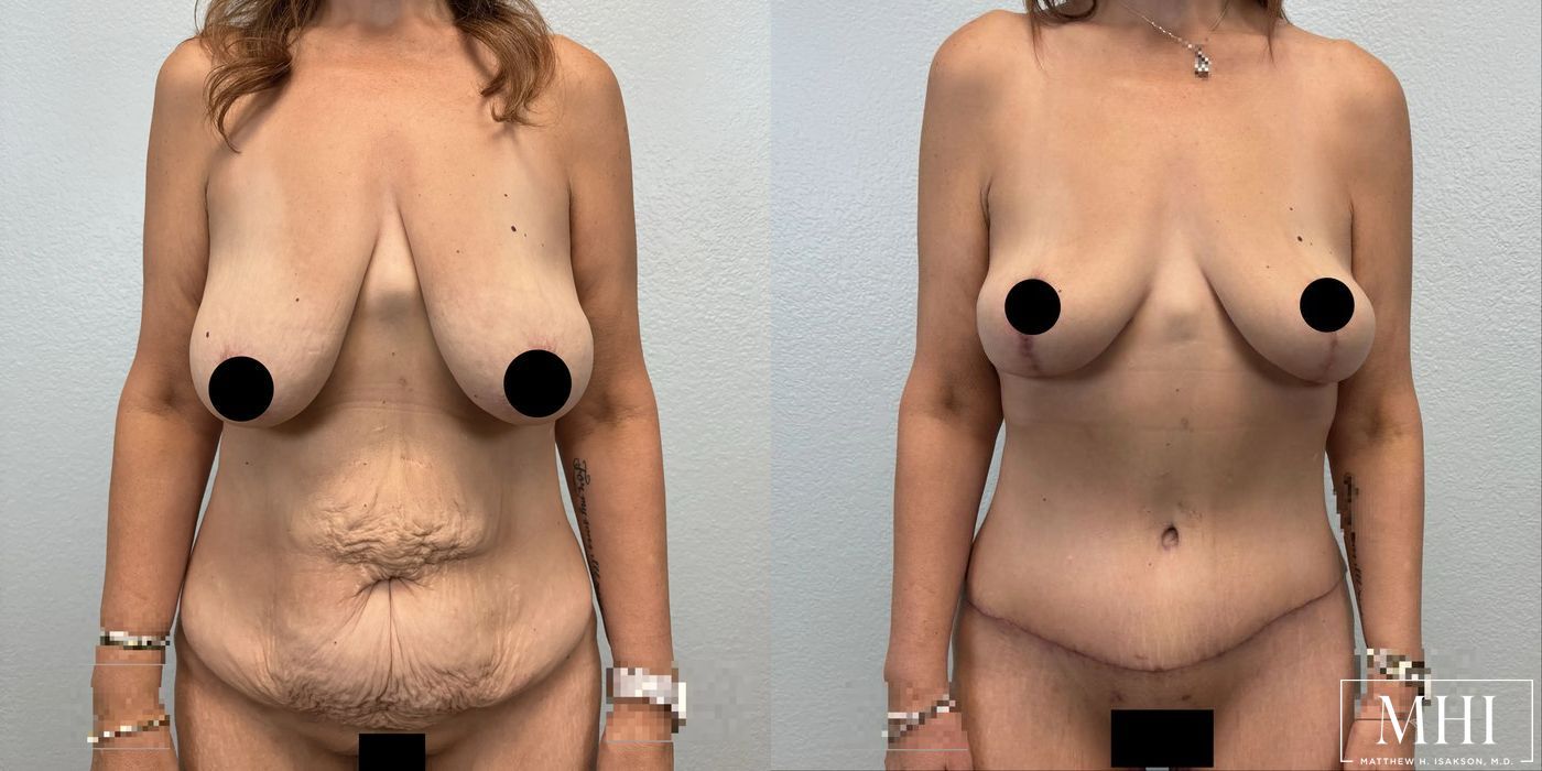 Breast Lift - Case 12104