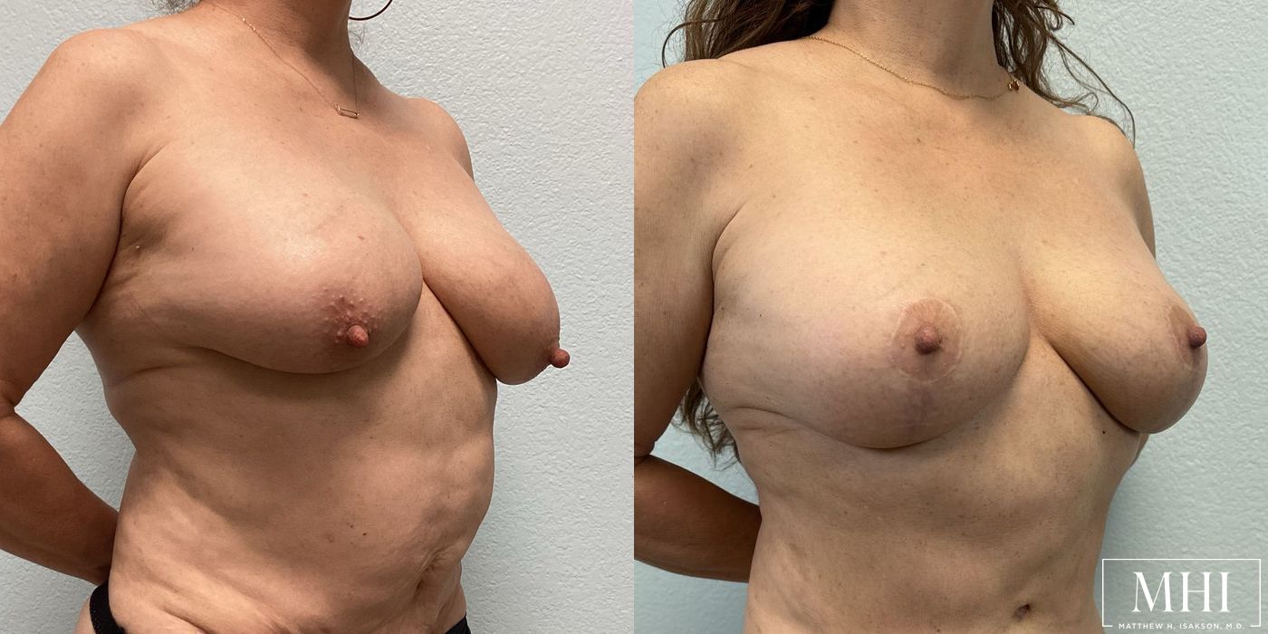 Breast Lift - Thumbnail 4