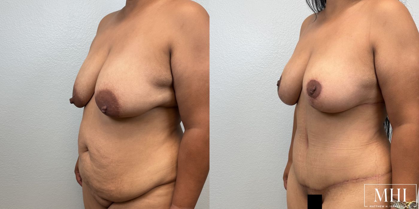 Breast Lift - Thumbnail 3