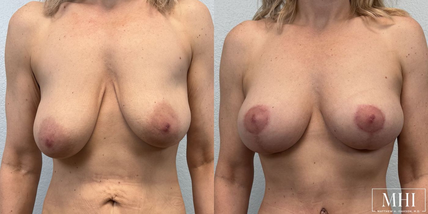 Breast Lift - Case 12153
