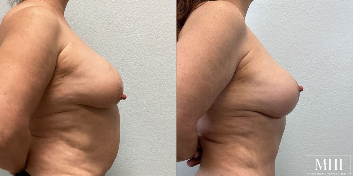 Breast Lift - Thumbnail 5