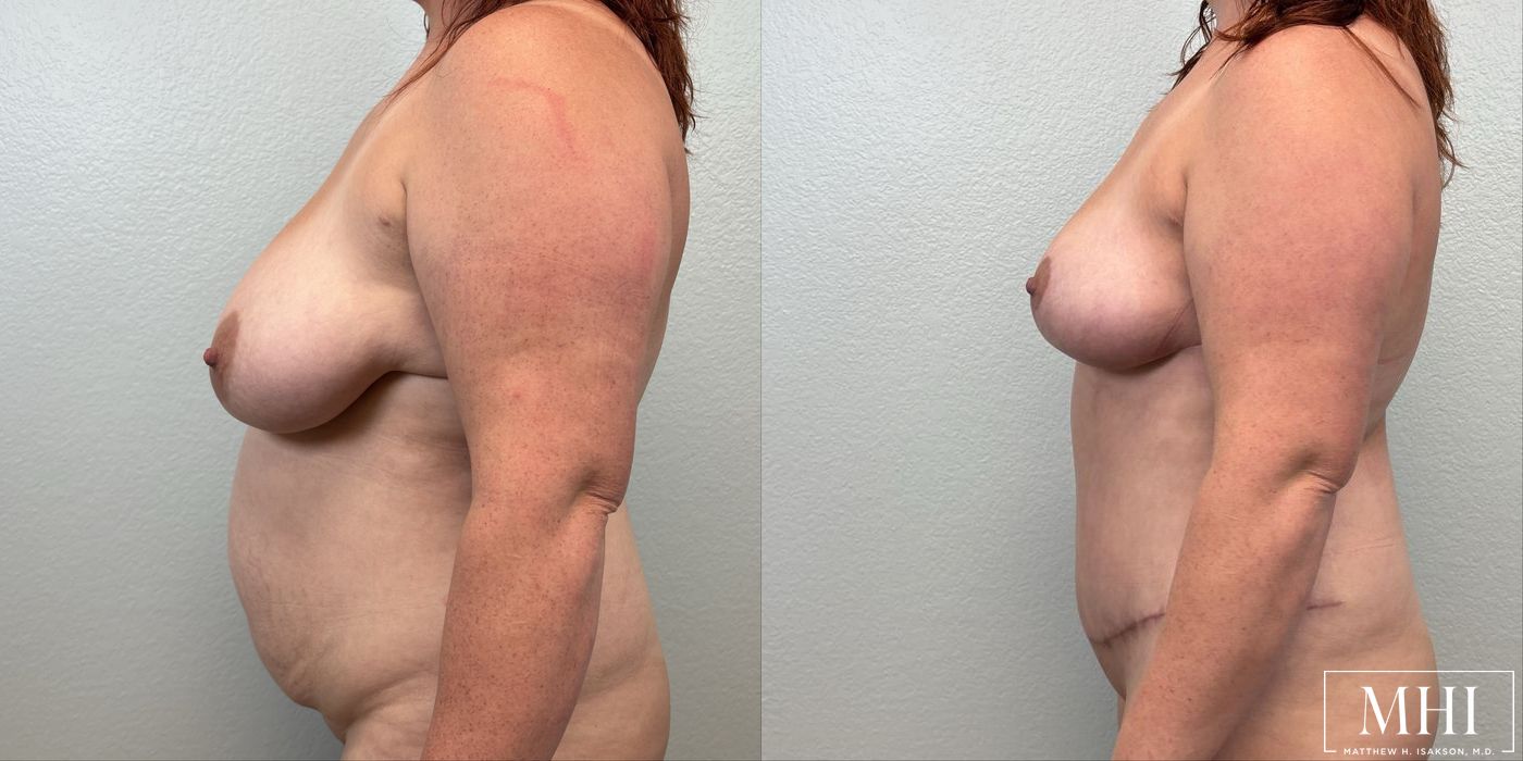 Breast Lift - Thumbnail 3