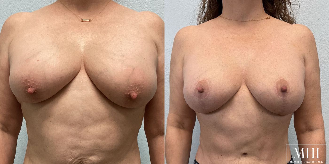 Breast Lift - Case 12163